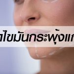 ศัลยกรรม-ตัดไขมันกระพุ้งแก้ม