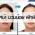 ดึงหน้า-Facelift