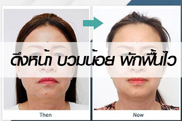 ดึงหน้า-Facelift