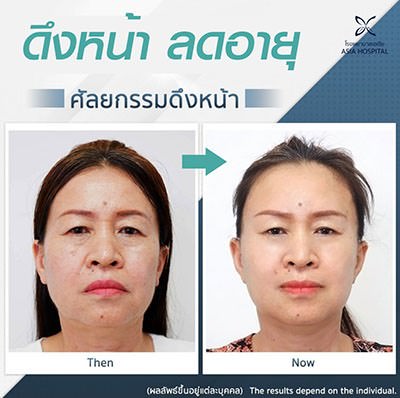 ดึงหน้า